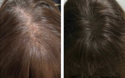 Tricopigmentation Capillaire et Effet Densité : Une Solution pour les Femmes à Rouen