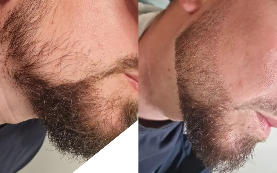 Tricopigmentation Capillaire à Rouen : Une Solution Idéale pour la Barbe