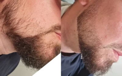 Tricopigmentation Capillaire à Rouen : Une Solution Idéale pour la Barbe