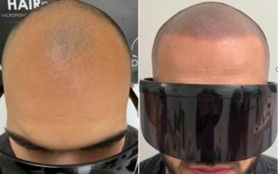 Tricopigmentation Capillaire Rouen et Micropigmentation Capillaire : La Solution  pour l’Effet Rasé Parfait